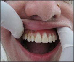 Fig.6 Shows maxillary denture in patient