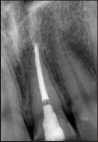 Fig 2 : Pre-operative radiograph of patient