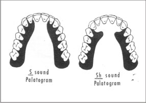 Fig. 4 - Palatogram during production of 